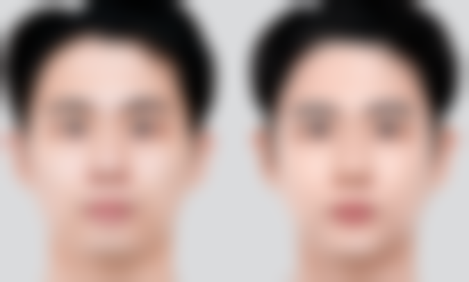 抽脂填胸有什么副作用：结节——胸部里的“硬块”困扰