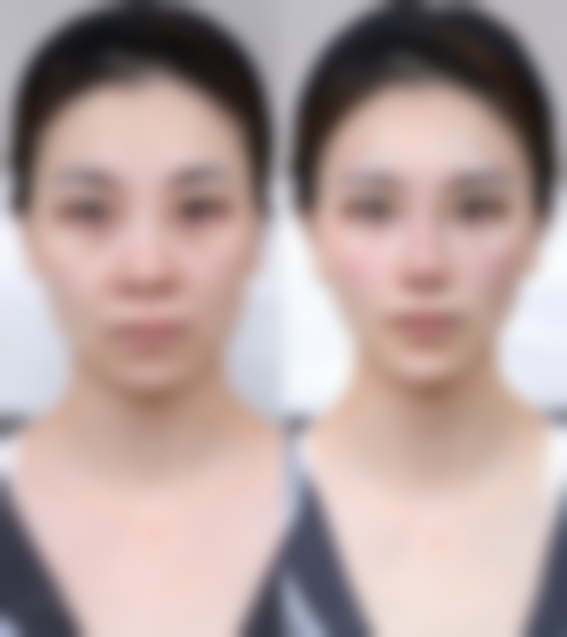 六大神奇穴位大公开：开启艾灸去眼袋的关键密码