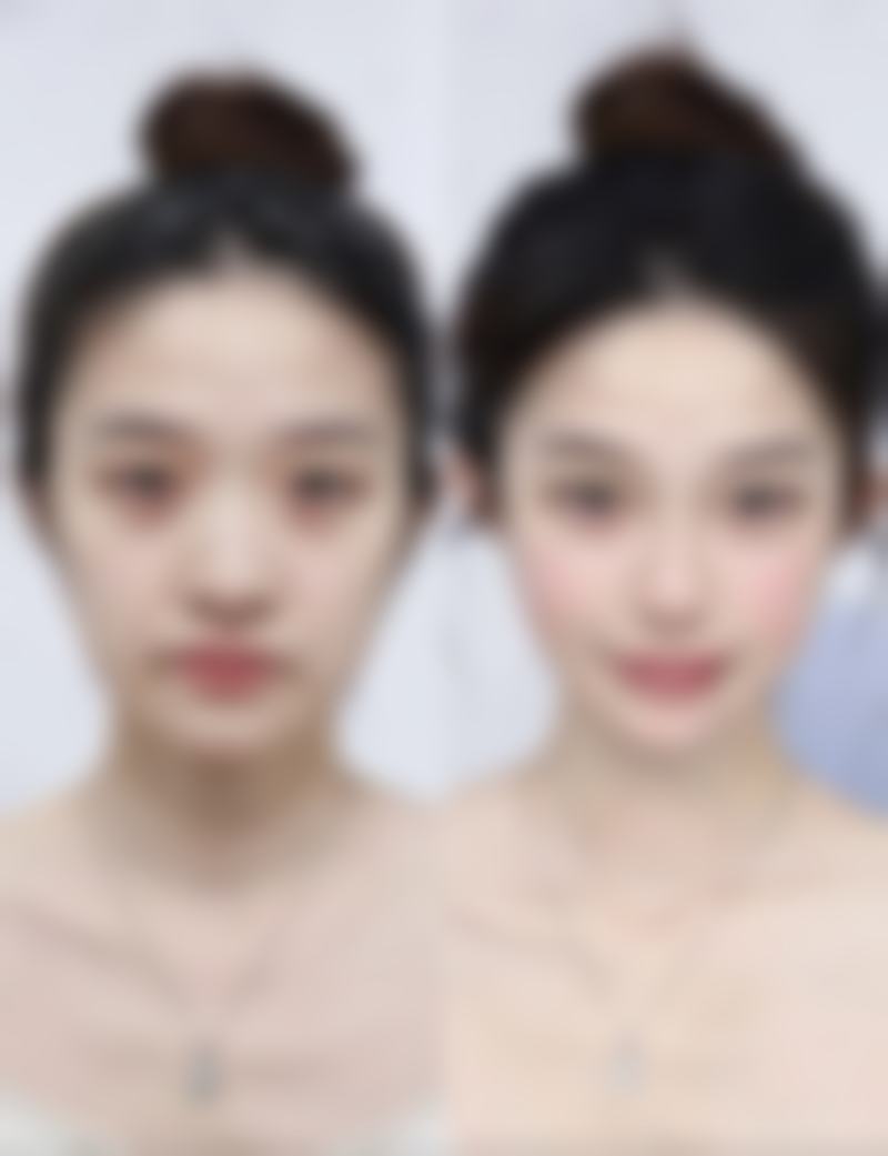 盐水假体隆胸的成效能保持多久