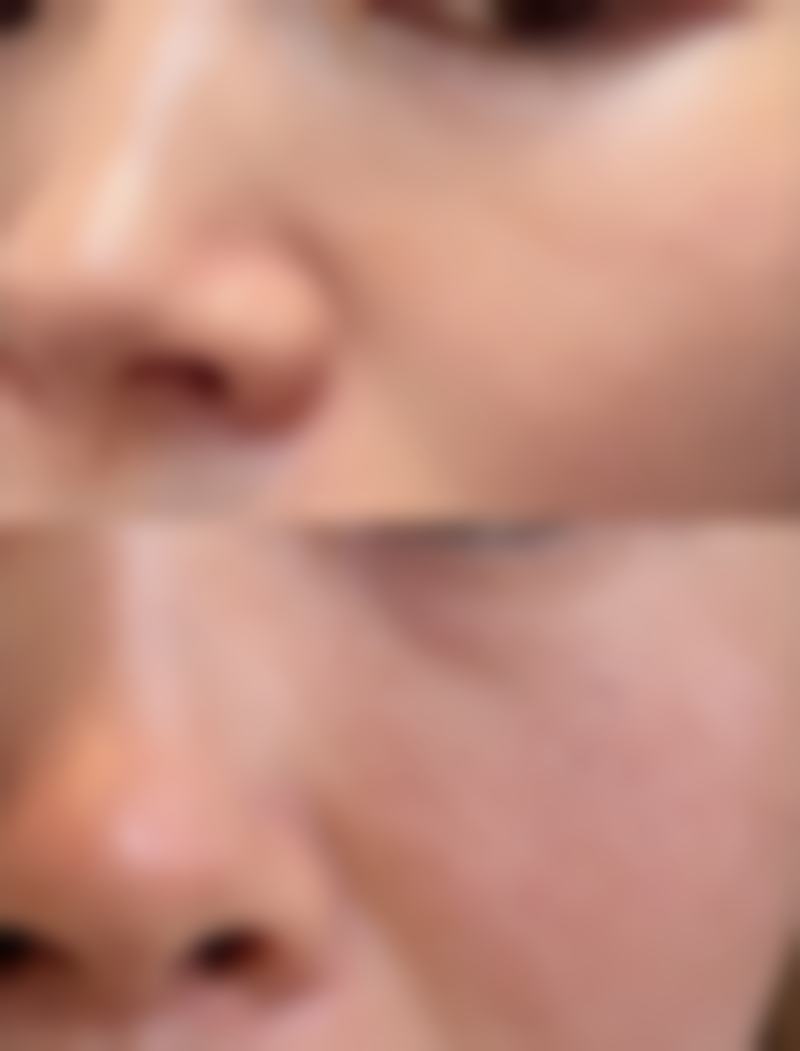 去除黑眼袋用什么？眼霜护理+手术填充等实用靠谱方法全解析