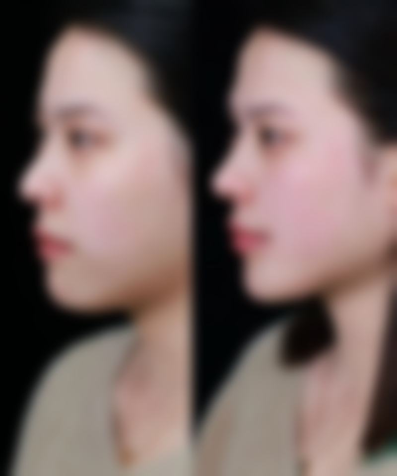 七、抽脂手术感染有危险吗？——从轻微红肿到致命败血症