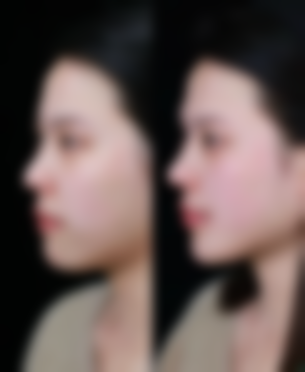 耳软骨隆鼻需要住院吗——广东东莞华美口腔美容中 心