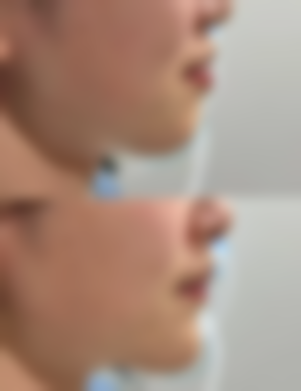 耳软骨隆鼻需要住院吗——青岛友谊医院整形美容科