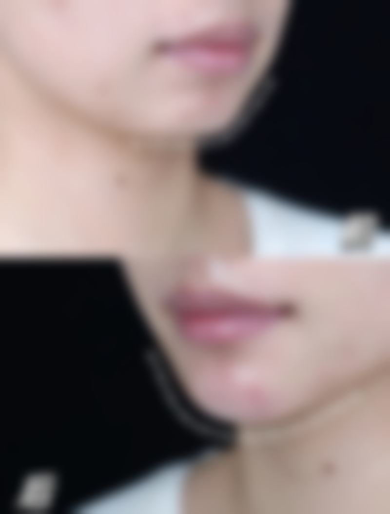 割了双眼皮术后感染应急处理指南