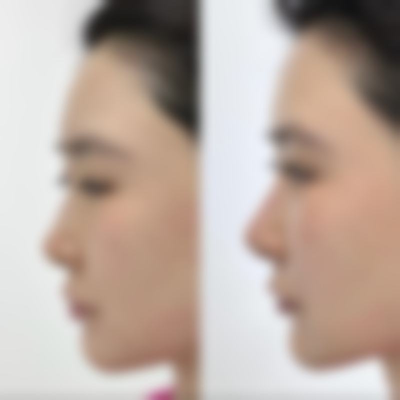 咬伤疤痕怎么去除——XX第一医院