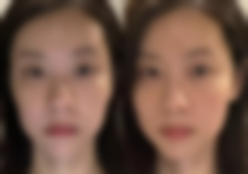 处女膜修复手术：医院选择与手术方式对疤痕的影响