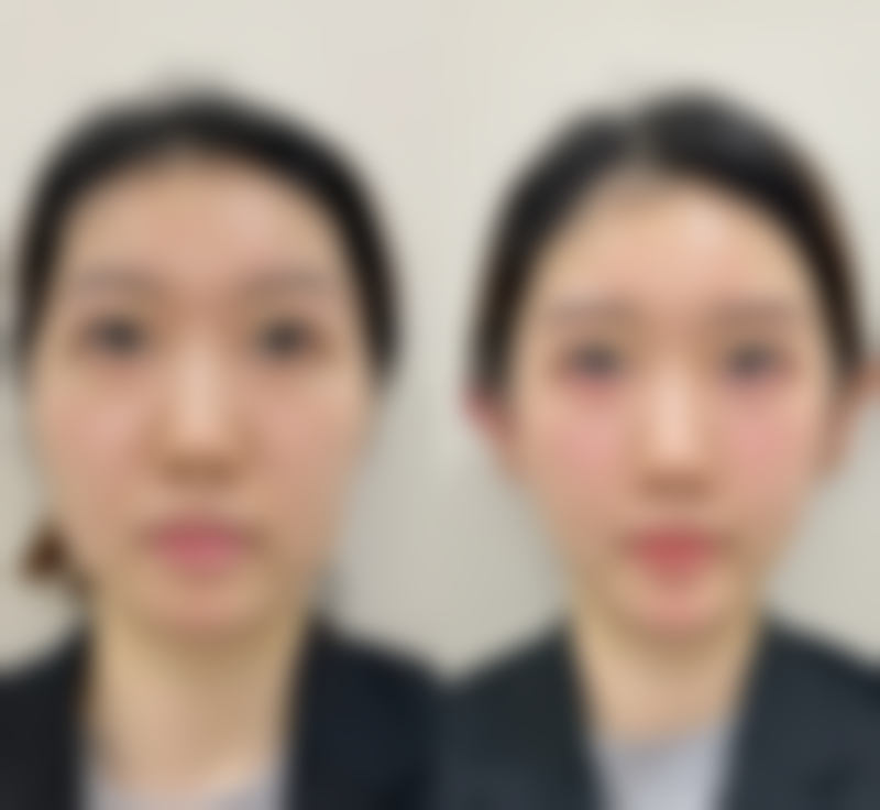 怎么可以让三眼皮变回双眼皮——上海天坛普华