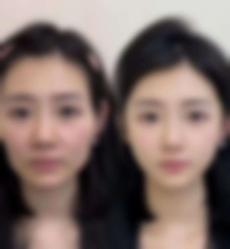 艾条去除眼袋的原理剖析：中医与现代医学的双视角解读