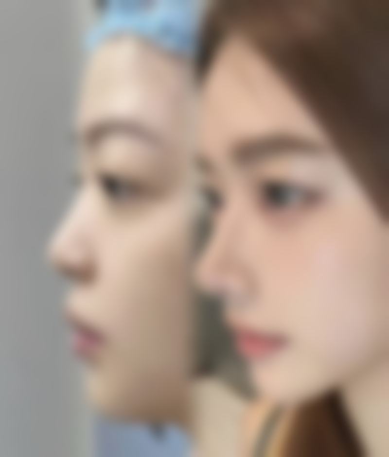 耳软骨隆鼻需要住院吗——青岛致美尚美美容诊所