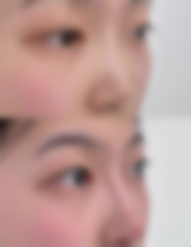 如何使刀伤老疤痕修复：医院特色疗法消除线性印记