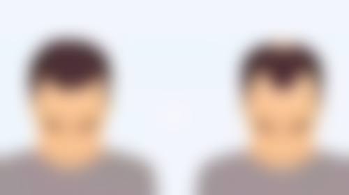 个人体质对大腿吸脂后消肿时间的决定作用