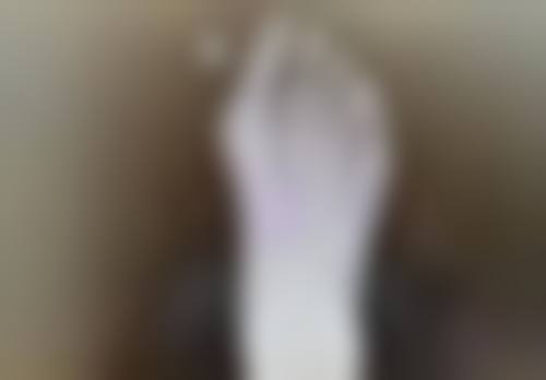 做双眼皮手术会有危险吗之特殊人群避雷指南——干眼症患者