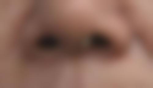 隆鼻硅胶膨体哪个好——成都八大处整形