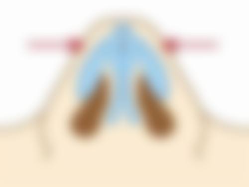 避开雷区：那些年我们犯过的双眼皮后洗脸错误