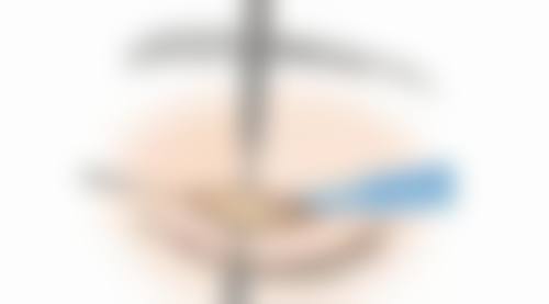 做双眼皮手术会有危险吗之不同手术方式的风险差异——全切法：一劳永逸的“双刃剑”