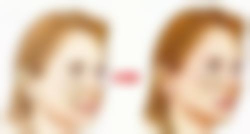 乳房大抽脂的医院评估与适合人群