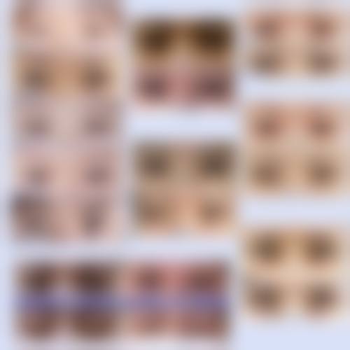 长期的下眼袋怎么去除——成都高新春天医疗美容门诊部