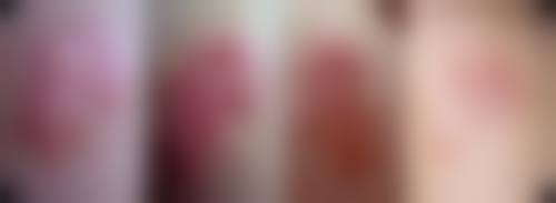 色素疤痕怎样祛掉？鹏程马爱红激光淡疤 个性化诊疗重现肌肤本色