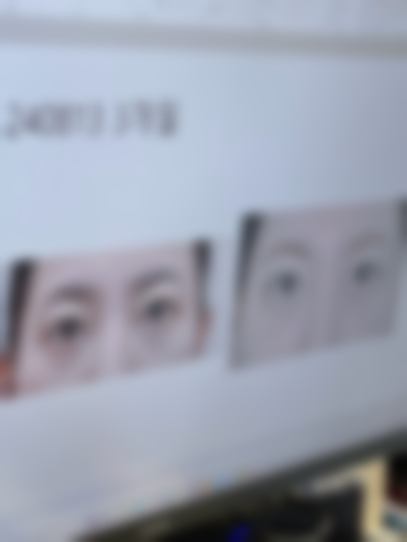 长期的下眼袋怎么去除——嘉兴南湖颜芝美