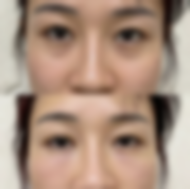 大腿吸脂后消肿时间受抽脂量影响几何