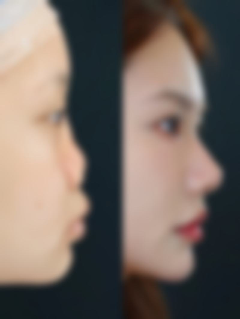 隆鼻硅胶膨体哪个好——深圳八大处整形