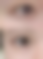 长期的下眼袋怎么去除——武汉大学中南医院整形美容科