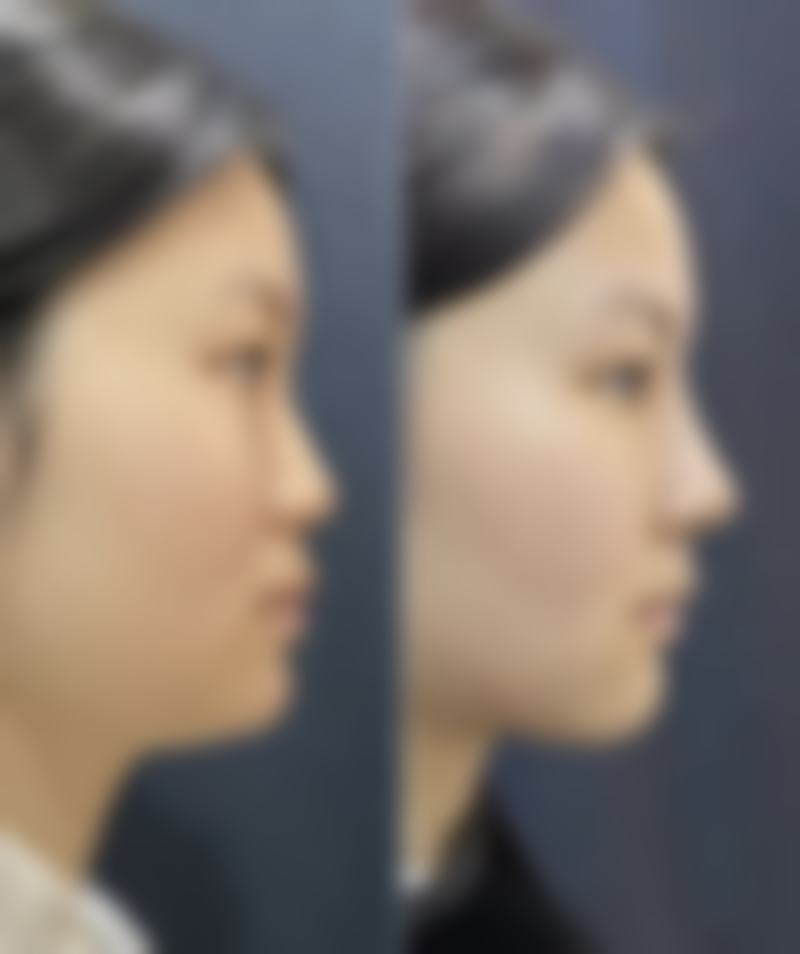 为何我的大腿吸脂消肿比别人慢