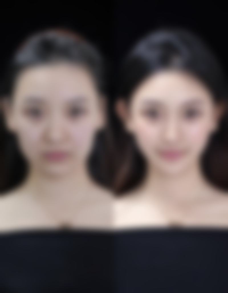 疤痕疙瘩会慢慢的自己消退吗——为何难以自行退场