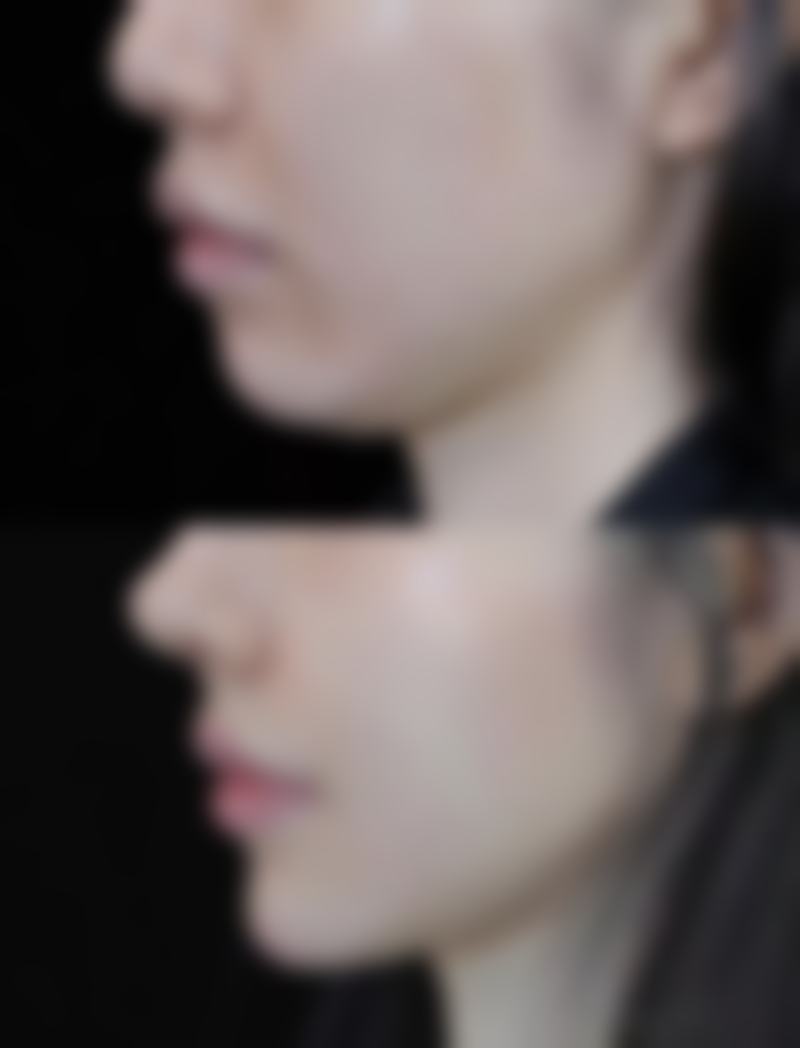 南京哪个隆鼻比较好——术后护理小贴士