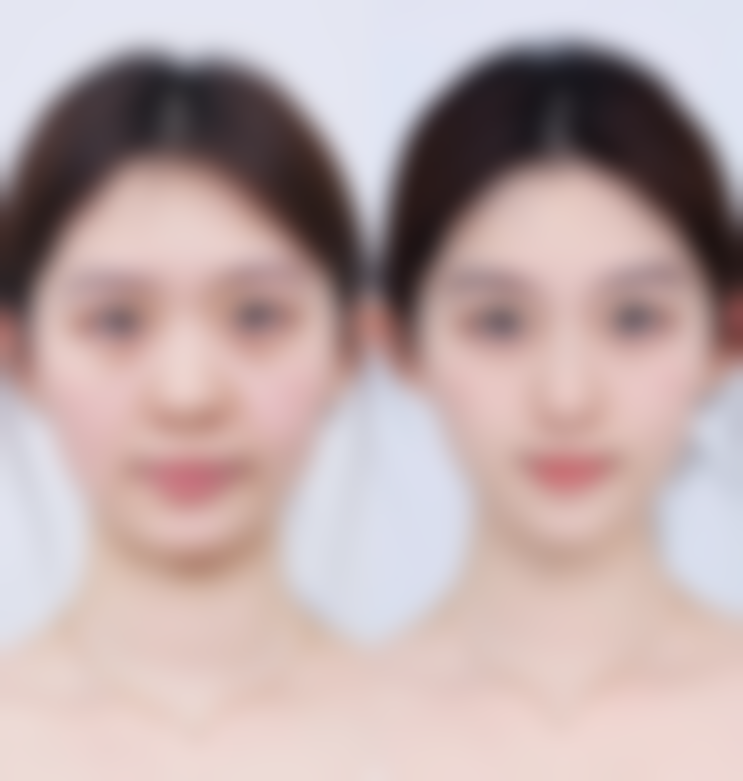 本地医院与外地医院权衡下头发种植能保持多久时间