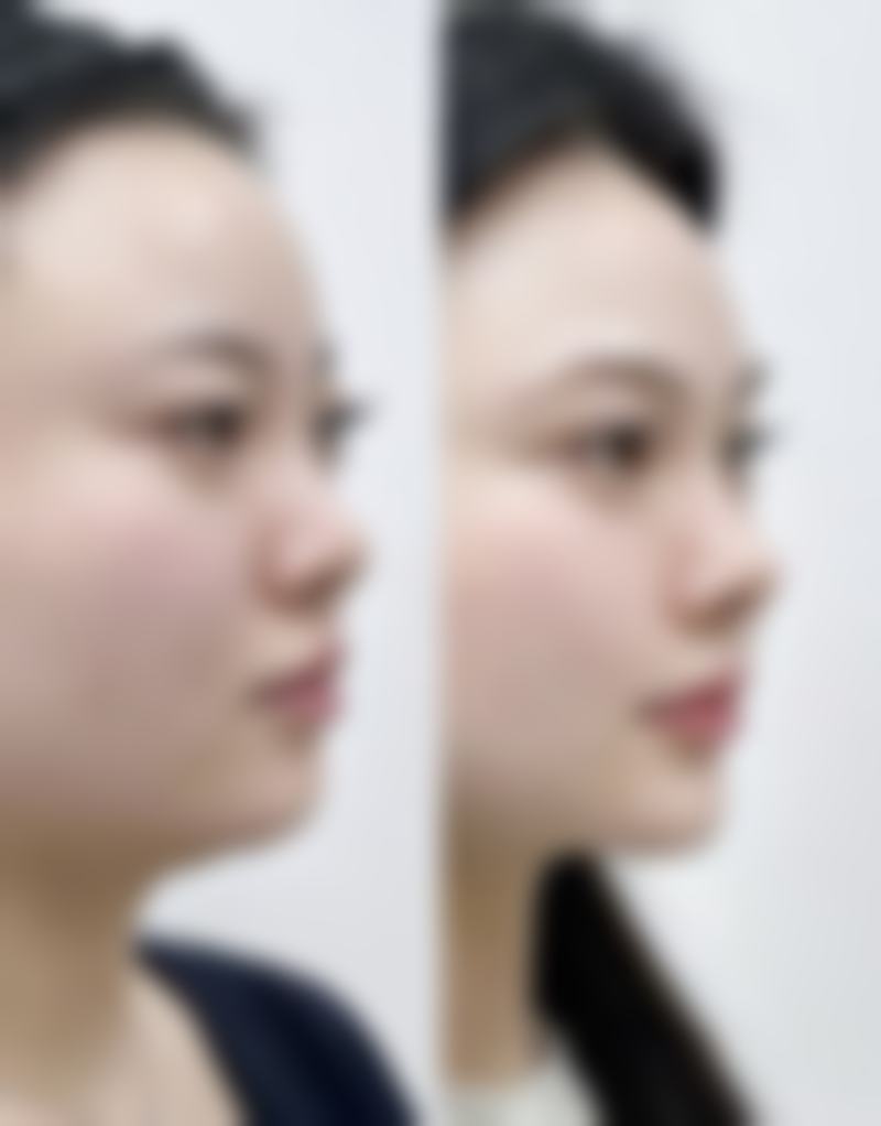 凸出疤痕怎样变平之手术修复的终极手段