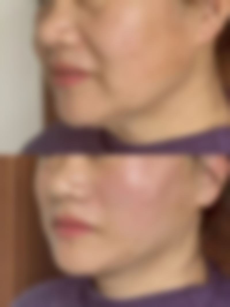 做双眼皮手术会有危险吗之不同手术方式的风险差异——埋线双眼皮：温柔的“陷阱”