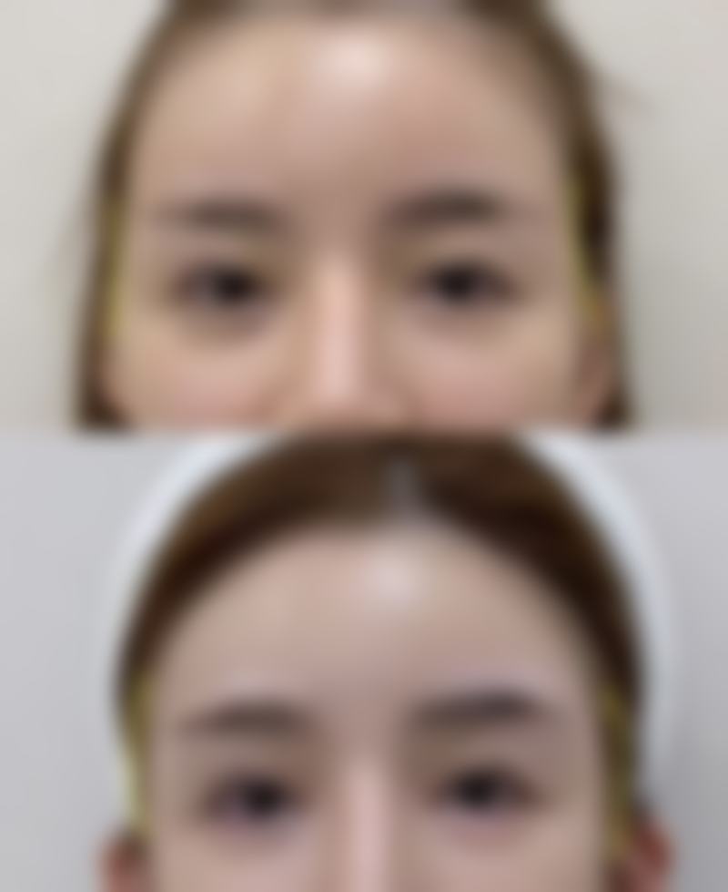 乳房大可以抽脂吗