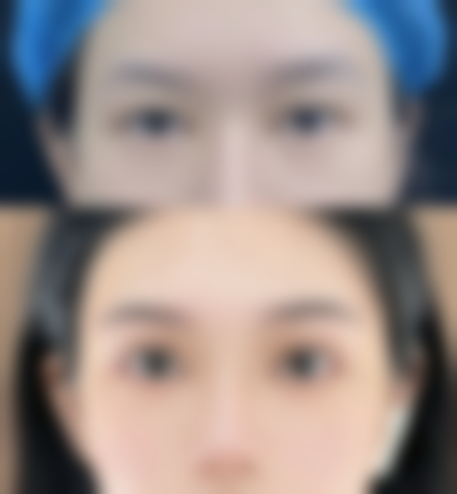 疤痕疙瘩会慢慢的自己消退吗？专家揭秘：不治疗会持续增生，自然消退可能性极低