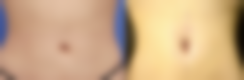 疤痕疙瘩不治疗的后果——症状加重：从“小不适”到“夜不能寐”