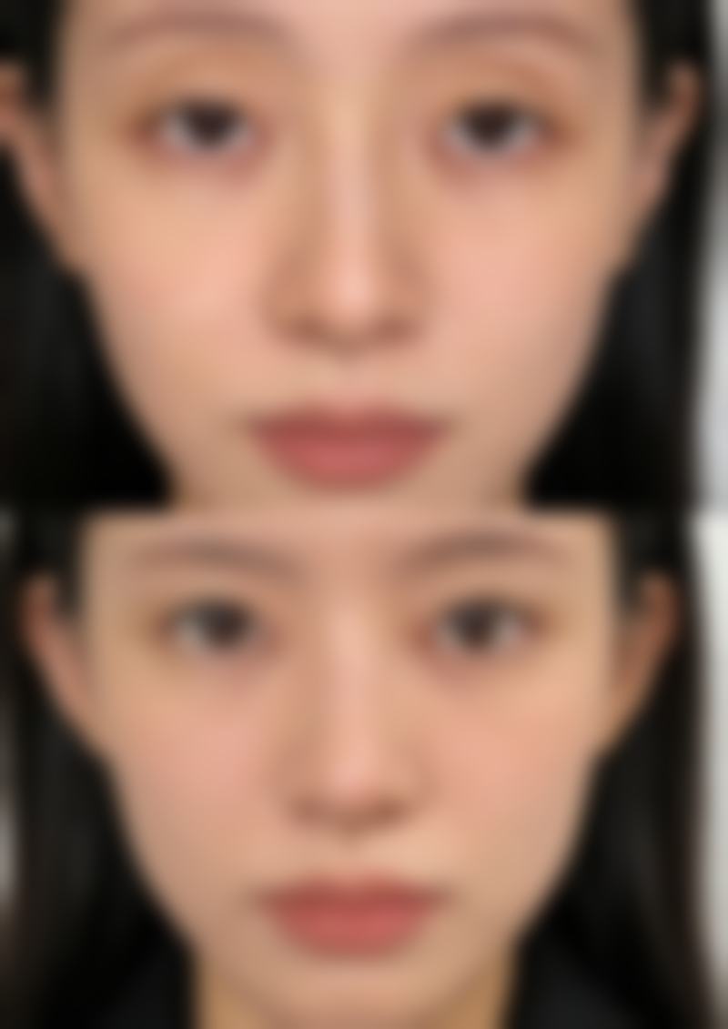 冰敷眼睛能消眼袋吗?常冬青医生有高招