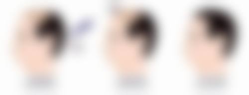 玻尿酸填充隆鼻要多少，北京协和1-2支/上海华美3000起，选对医院才靠谱