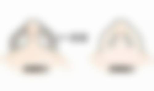 摔跤留下的凹陷疤痕怎么消除：填充与分离重塑肌肤