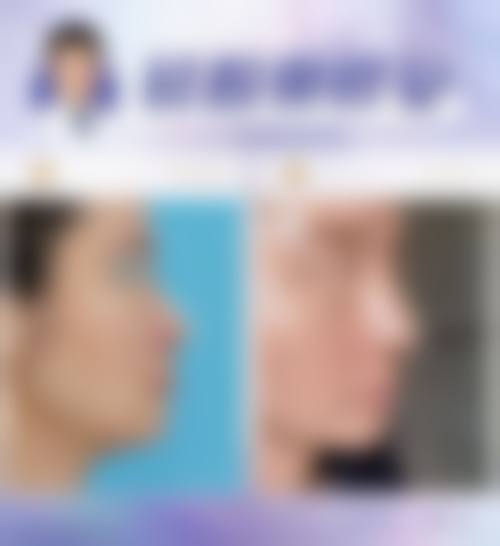 广州高尚医学美容中 心景丽峰面部填充领域的专精成就