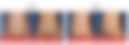 怎么消除男士下眼袋:专精治疗,解决顽固性眼袋