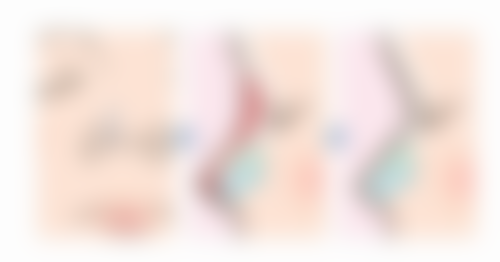 眼袋好显老怎么办:非手术治疗为轻度眼袋排忧解难