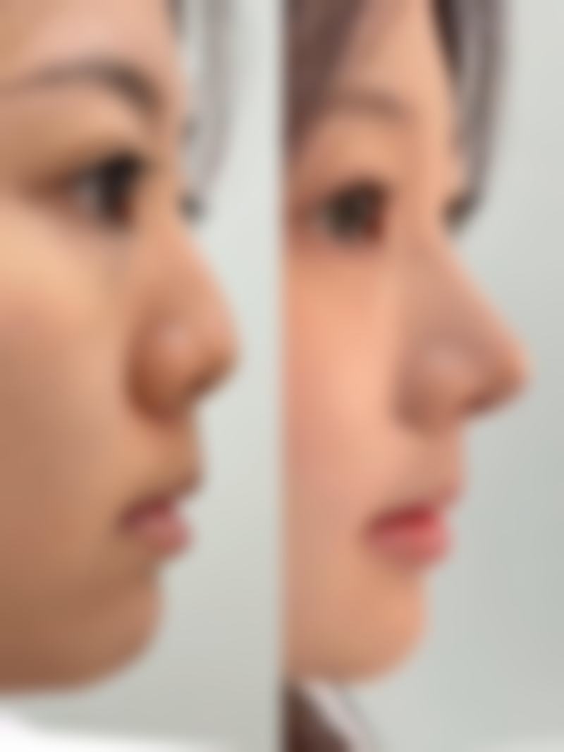 七毫米的双眼皮会成内双吗——常冬青医生在北京的诊所