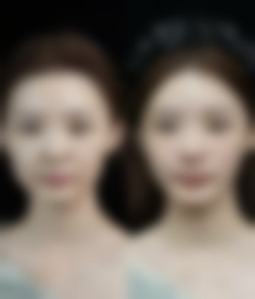 注射隆鼻：1 - 2年的“临时改造”