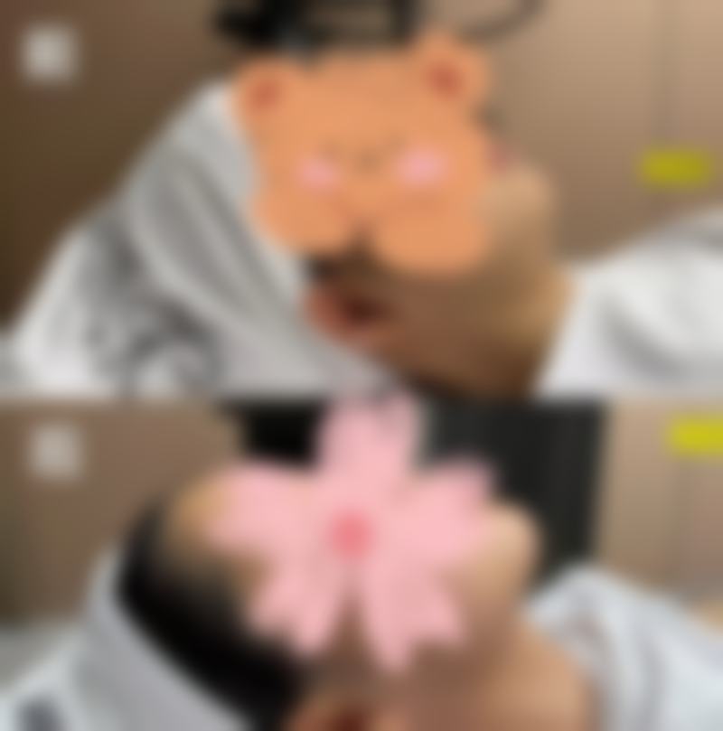 怎样去掉黑眼圈眼袋？居家护理+医美方案帮你有效改善眼周问题