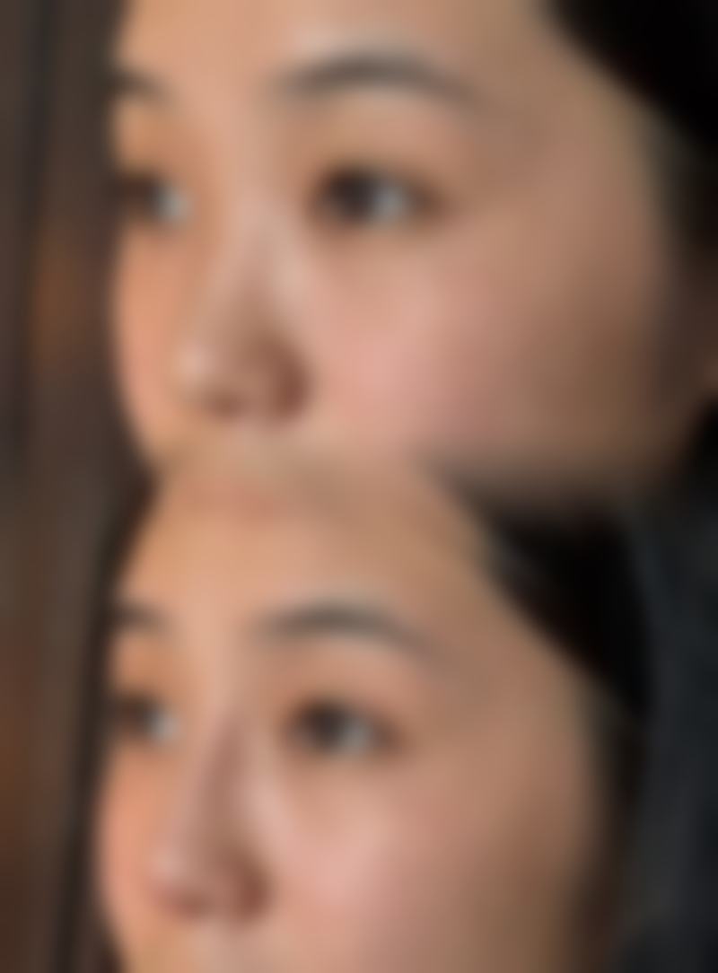 割双眼皮修复饮食的时间受哪些个体因素影响