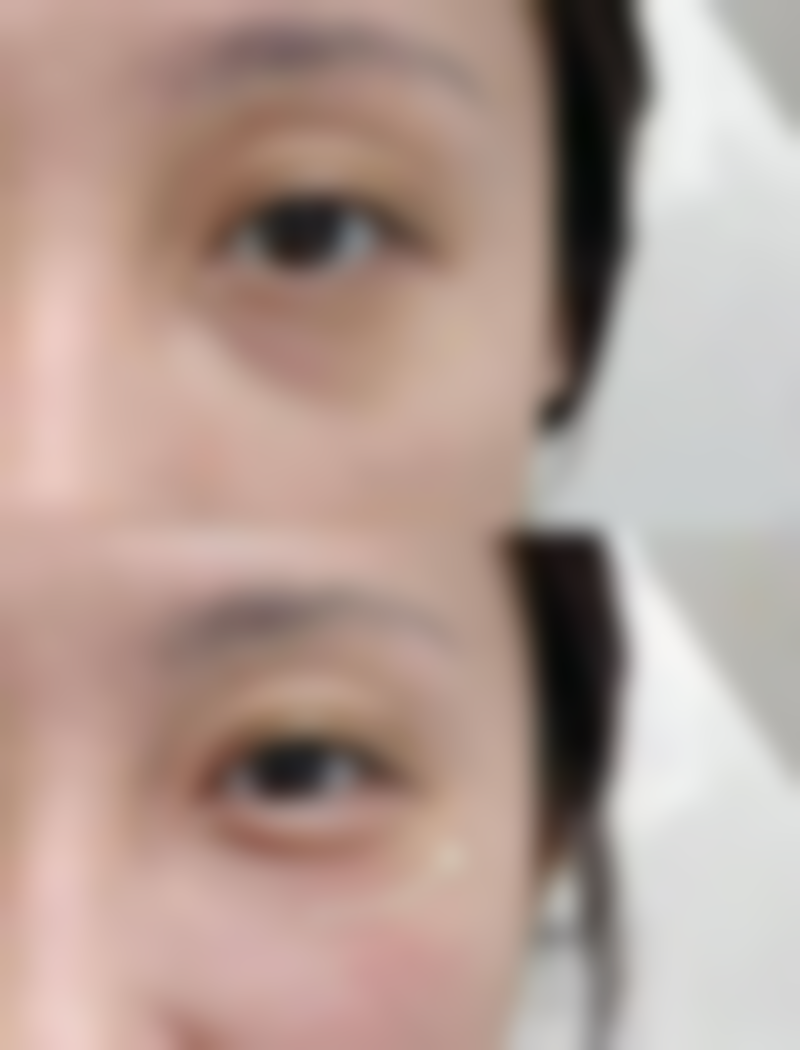 如何判断是否是疤痕体质之疤痕体质科学护理：呵护肌肤，减少疤痕