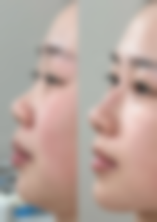 鹅蛋脸:什么脸型需要打瘦脸针之鹅蛋脸非必要选择