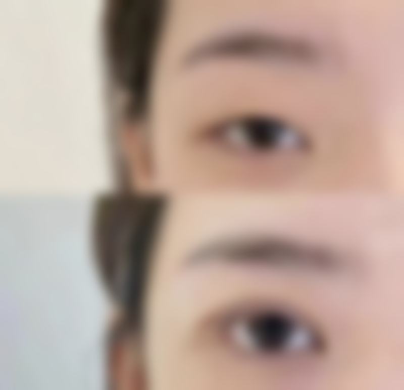 做双眼皮抹什么能消肿？医生指导选药+多款消肿药膏参考推荐