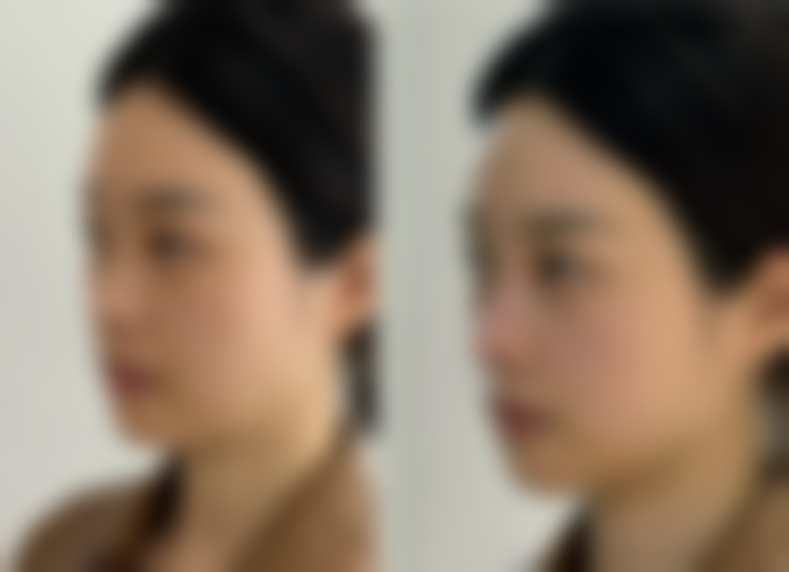 哪种隆鼻方式比较好之综合隆鼻：理想定制的方案