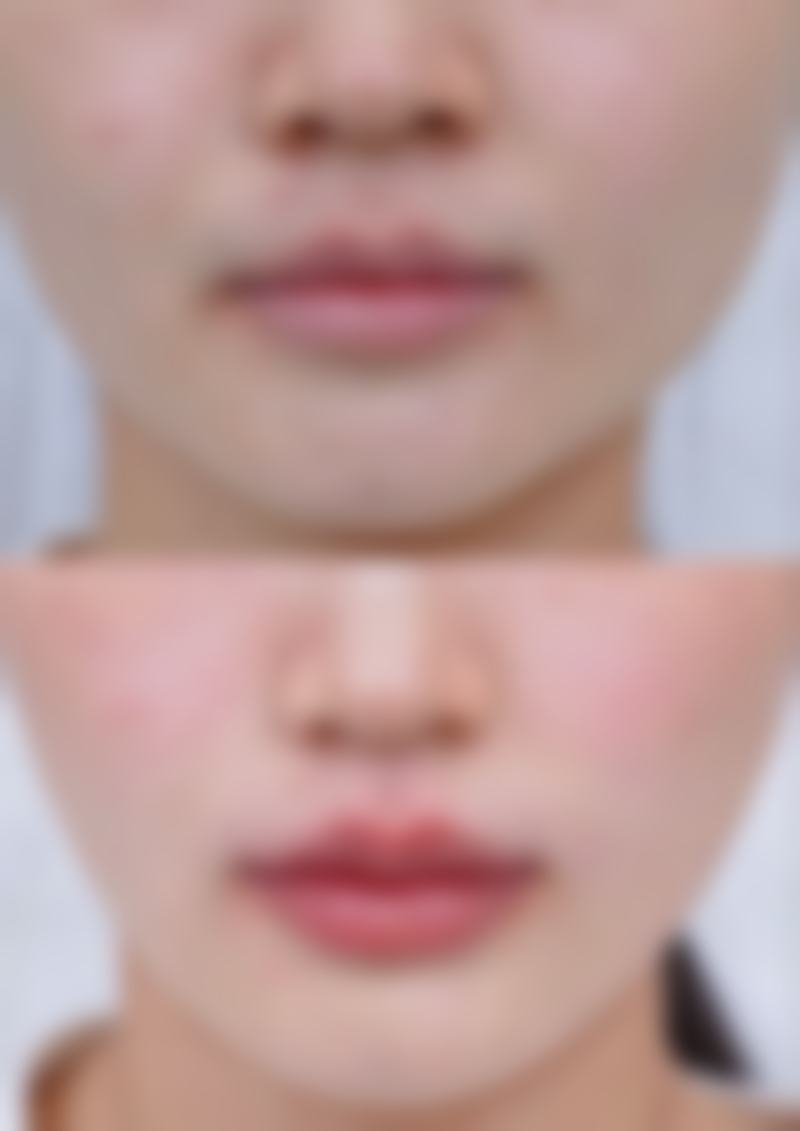 心形脸:什么脸型需要打瘦脸针之心形脸精致抉择